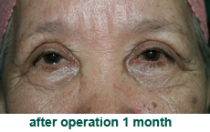 plastic-surgery-blepharoplasty